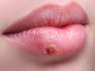 герпес на губе