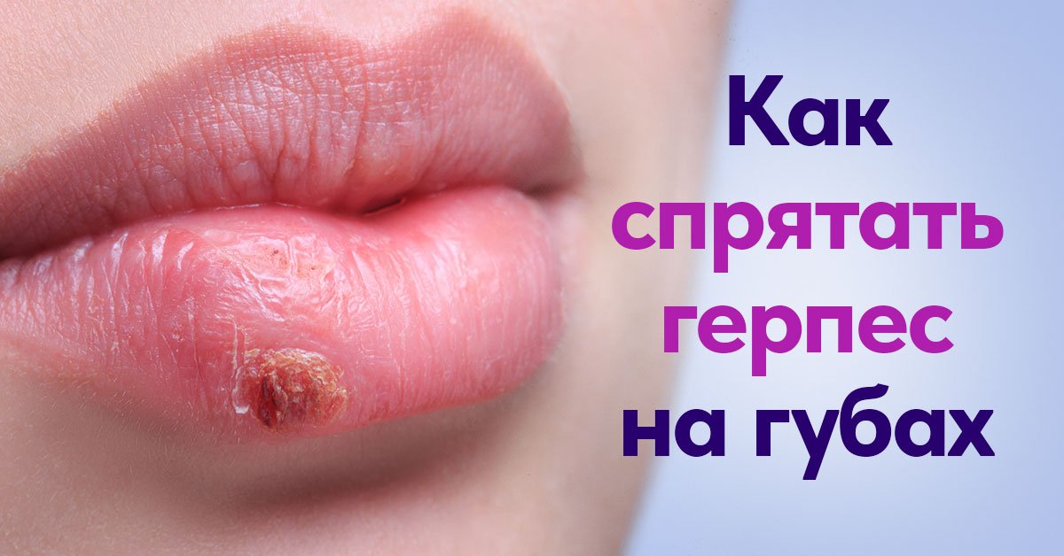 Герпес на губе: проверенные приемы маскировки