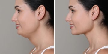 второй подбородок