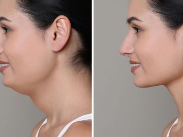 второй подбородок