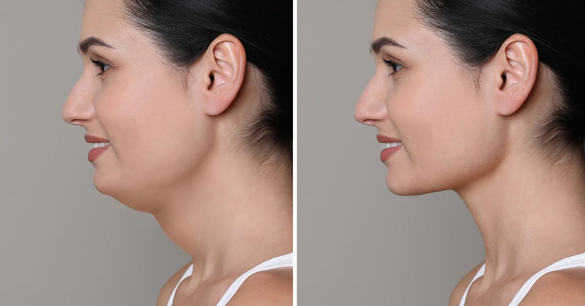 второй подбородок