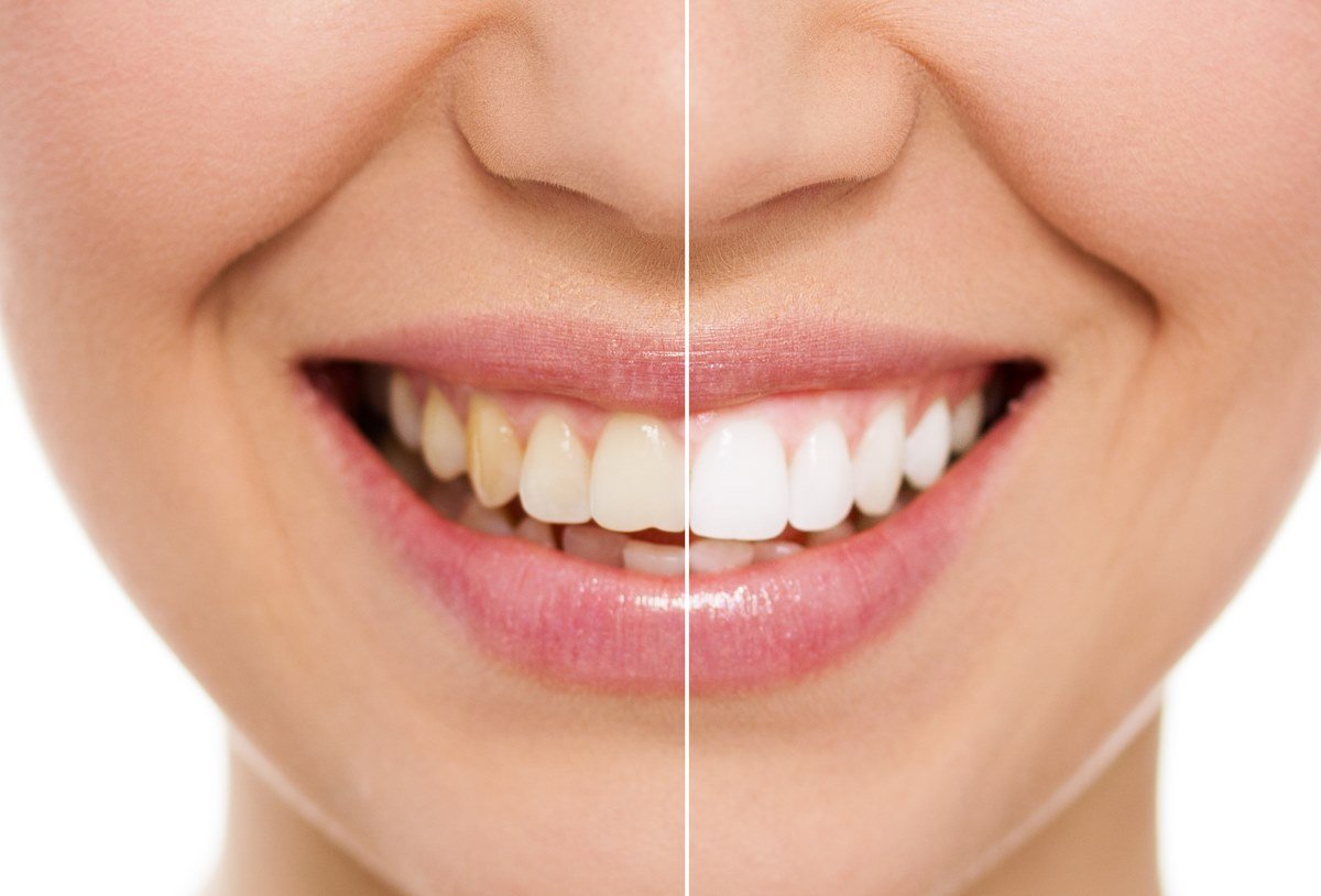 фото зубов до и после